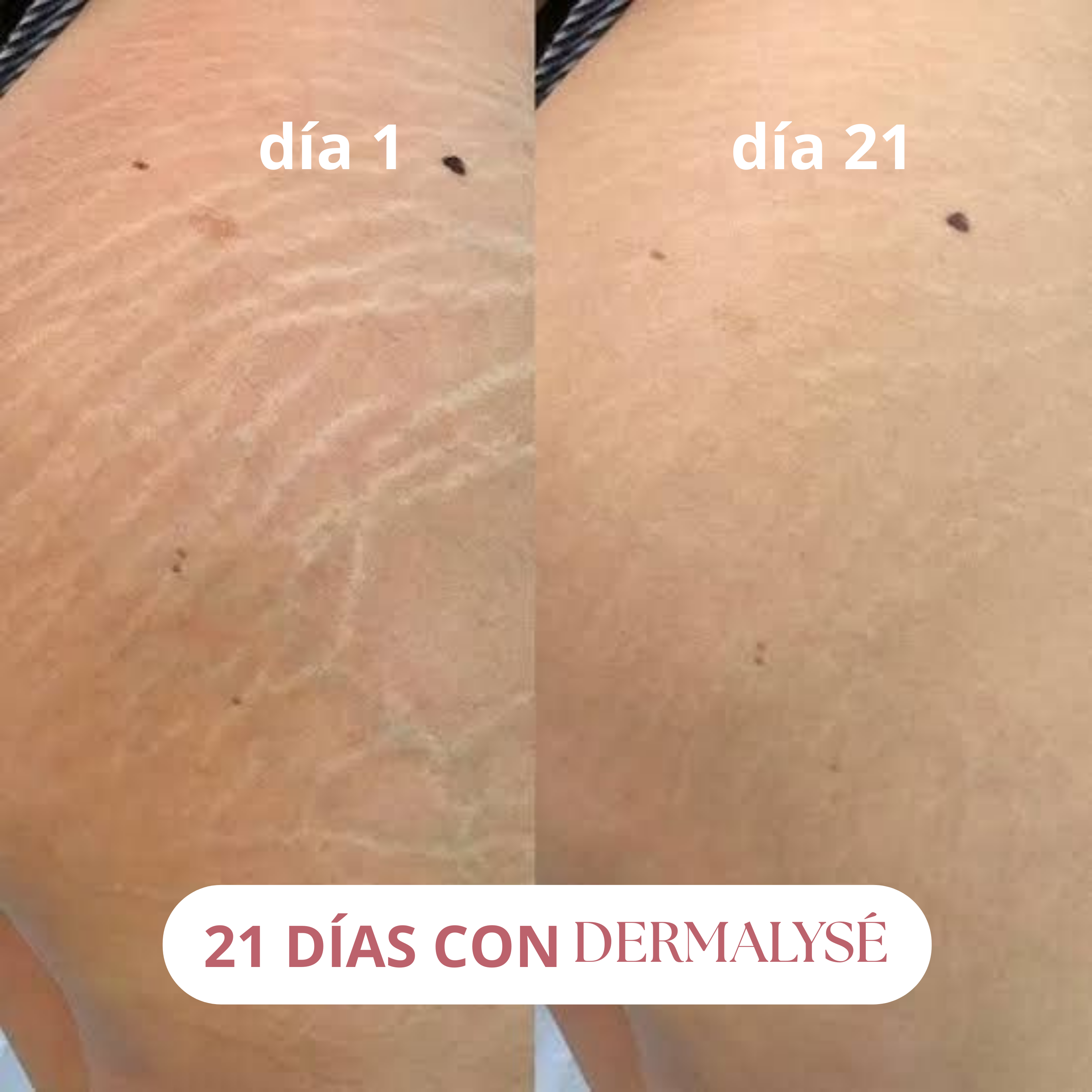 DERMALYSÉ – Crema Anti Estrías y Firmeza 200ml