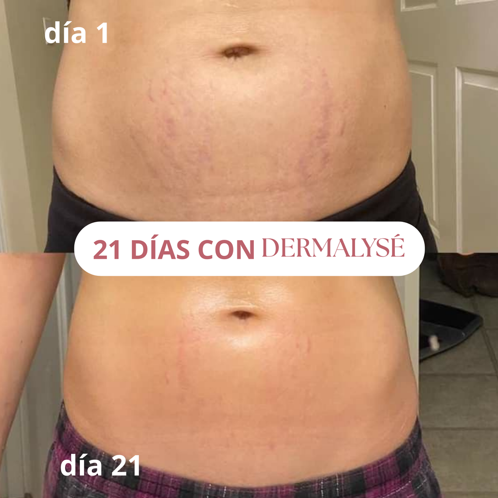 DERMALYSÉ – Crema Anti Estrías y Firmeza 200ml