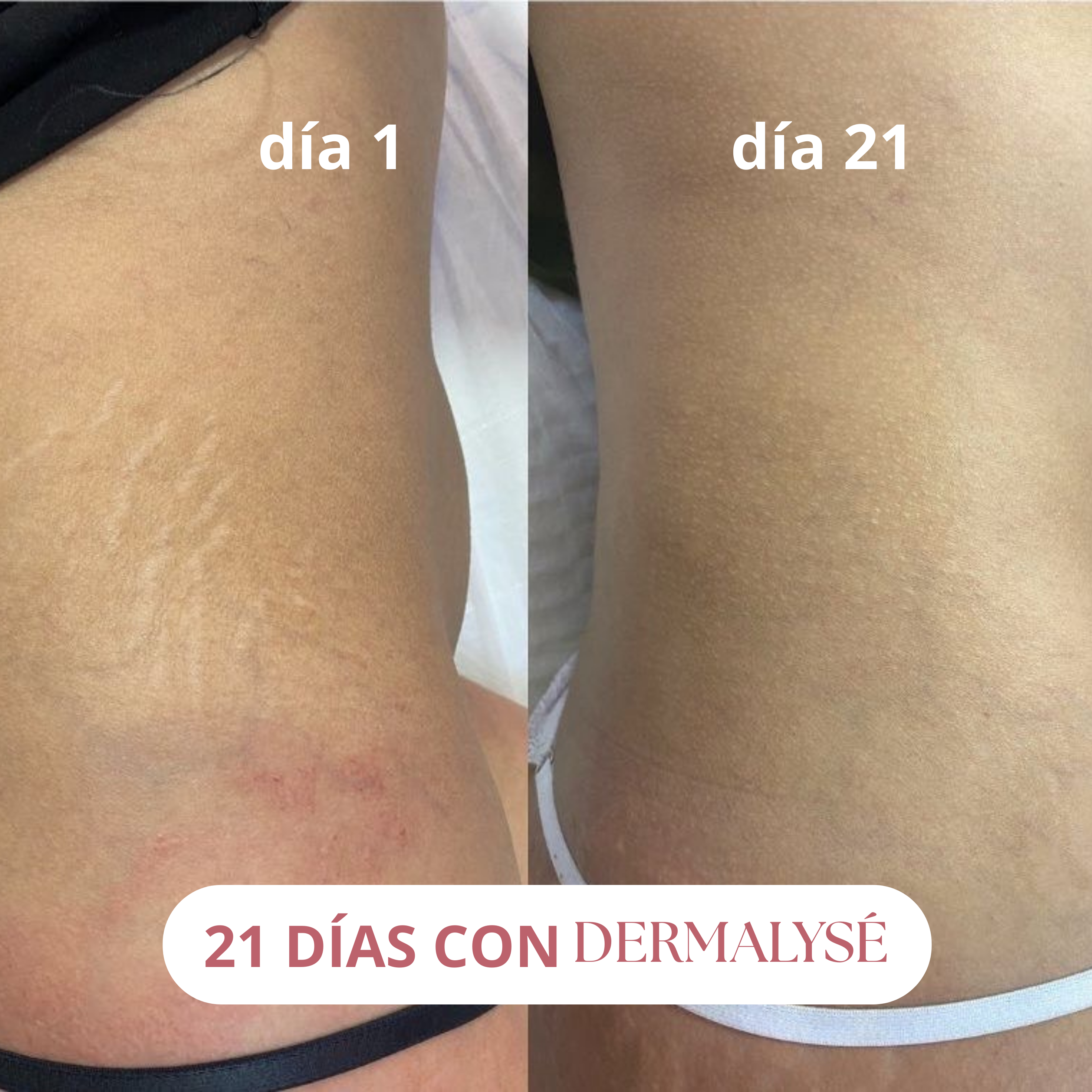 DERMALYSÉ – Crema Anti Estrías y Firmeza 200ml