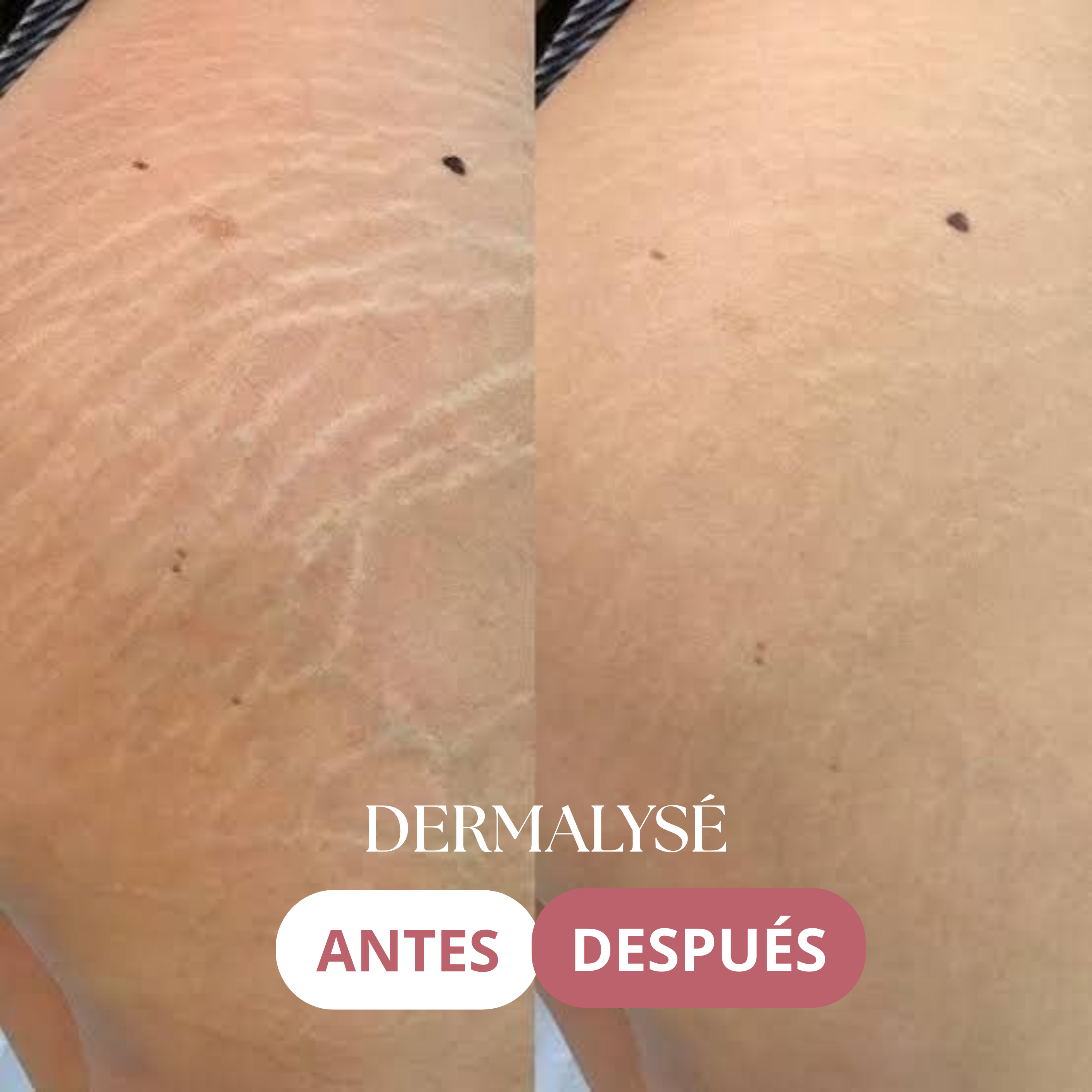 DERMALYSÉ - Tratamiento Reafirmante y Anti Estrías. - 200ML