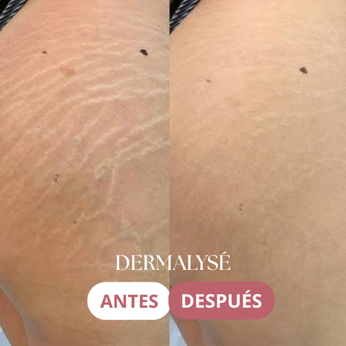 DERMALYSÉ - Tratamiento Reafirmante y Anti Estrías. - 200ML